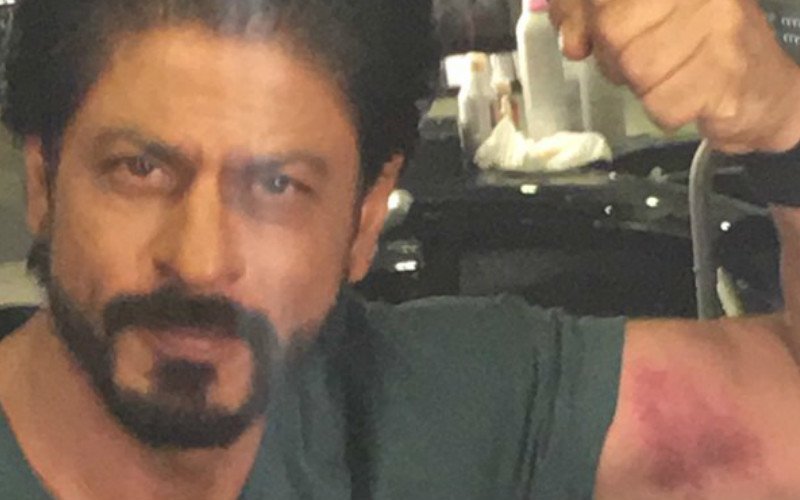 Shah Rukh Khan Flaunts His 'Love Bite'