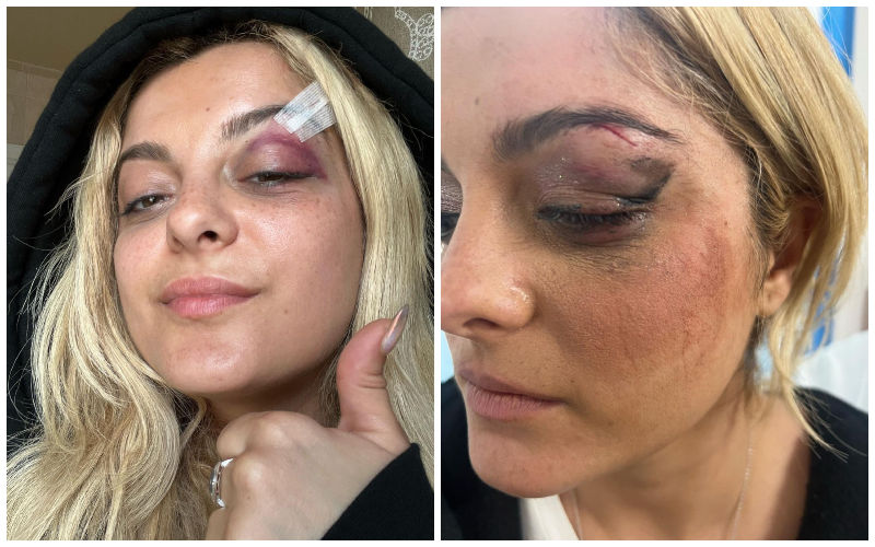 Pop star Bebe Rexha Gets Injured As A Man Purposely Threw Phone At Her Face During Live Concert! He ‘Thought It Would Be Funny’-WATCH VIDEO