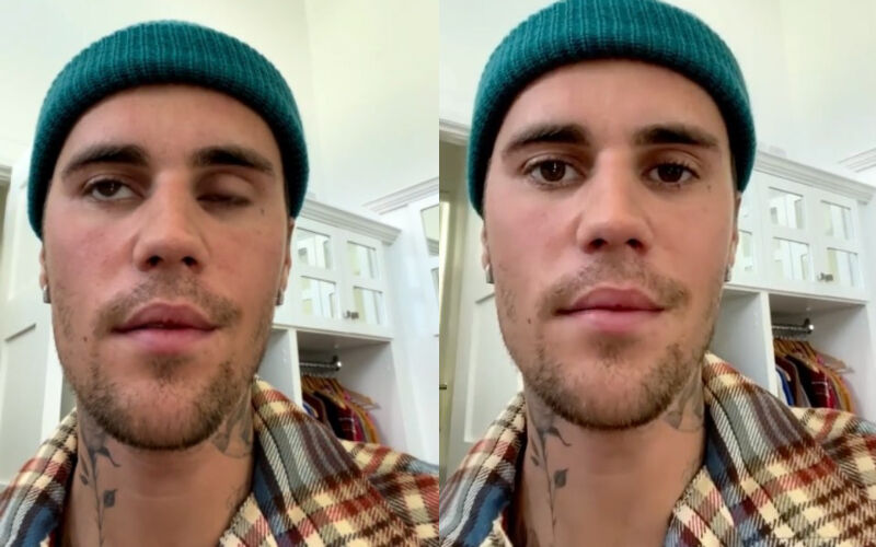 SHOCKING! Justin Bieber Reveals Right Side Of His Face Is Paralyzed Due To Ramsay Hunt Syndrome, Calls It 'Pretty Serious' Condition