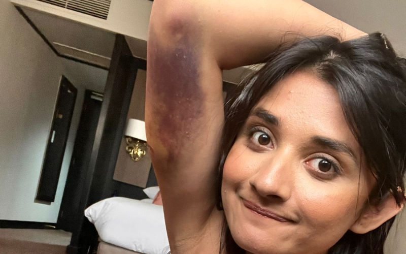 SHOCKING: Khatron Ke Khiladi 12 Contestant Kanika Mann Suffers Injury During The Show, Goes All Smiles In The Picture With Bruises
