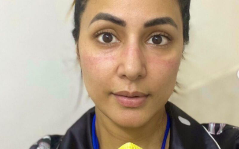 Hina Khan’s All Family Members Tested Positive For Covid-19, Actress Shares PICS Of ‘Battle Scars’ On Her Face For Wearing Masks -See Her POST