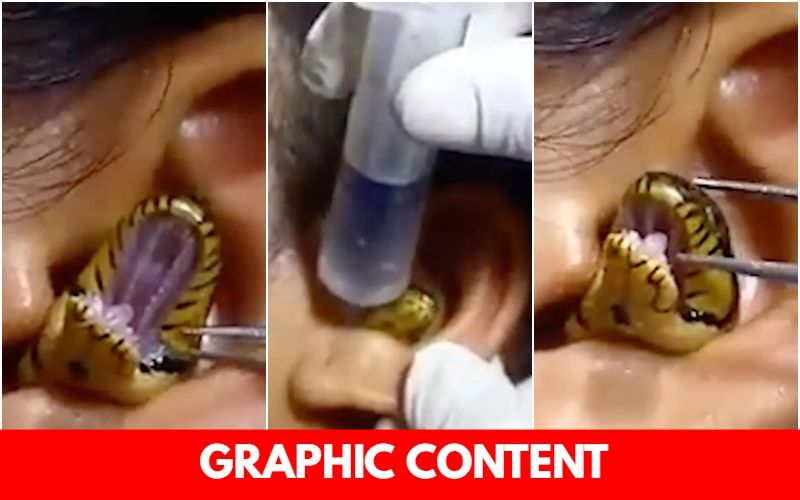BIZZARE! ‘Surgeon’ Struggles To Remove Live Snake From Woman’s Ear In Viral Video; THIS Spinechilling Clip Will Give You Goosebumps-WATCH