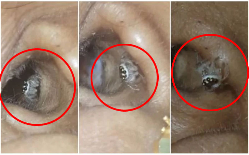 VIRAL! Spider Crawls Out Of Woman’s Ear Leaving Internet Shocked! Netizens Say, ‘New Fear Unlocked’!