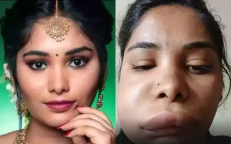 SHOCKING! Kannada Actress Swathi Sathish Gets Swollen Face After Botched Root Canal Surgery Goes Wrong; Looks Unrecognisable-SEE PICS