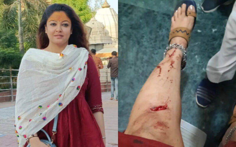 Tanushree Dutta Meets With An ACCIDENT After A Vehicle She Was Travelling In Had A BRAKE Failure; Actress Shares A PIC Of Her Bruised Leg