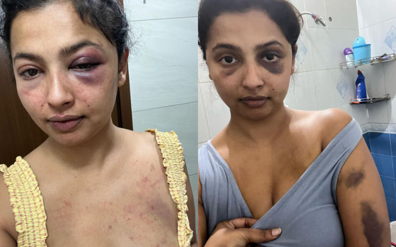 SHOCKING! Anicka Vijayi Vikramman Reveals She Was Mentally And Physically Tortured By Her Ex Boyfriend; Shares PICS Of Her Bruised Body And Face