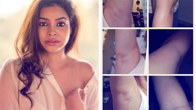 Shoddy Waxing Job: Sumona Chakravarti Sustains Bruises On Armpits & Ankles, Blasts Service Provider & Trolls