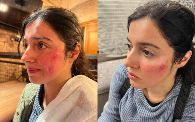 Divya Khosla Kumar Gets INJURED, Crashes Into An Iron Grill While Shooting For Her Upcoming Project; Actress Shares PICS Of Her Bruised Face