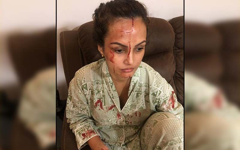 Nisha Rawal's Friends Release A SHOCKING Picture Of Nisha Soaked In Blood Amid Her Physical Altercation Case With Karan Mehra