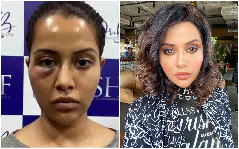 Bigg Boss Fame Raiza Wilson BLASTS Dermatologist Claiming She Was ‘Forced’ To Undergo A Procedure; Shares Pic After It Goes Wrong