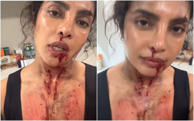 Priyanka Chopra Covered In Blood, Bruises And Scars From The Buff’s Shoot; Actress Says, ‘When You Do Action Movies, It's Really Glamorous’