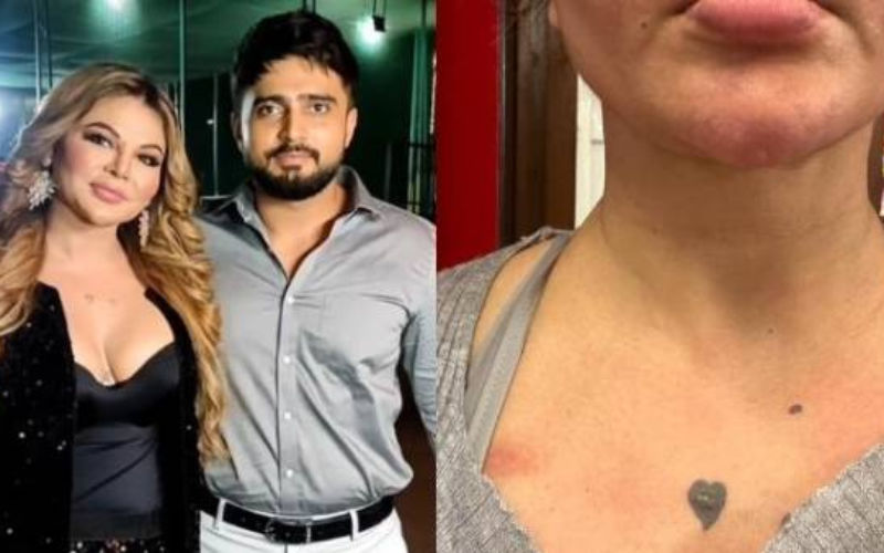 Rakhi Sawant Accuses Husband Adil Durrani Of Domestic Violence, Shows BRUISES On Face And Neck, Says He Physically Abused Her