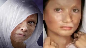 Chhapaak: Deepika Padukone Turns Acid-Attack Look Into TikTok Challenge; Gets Brutally Trolled On Social Media