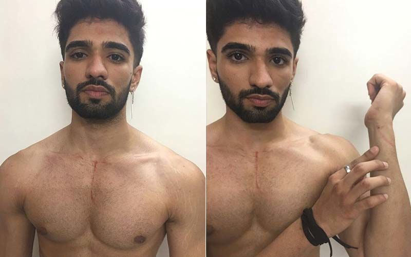 Bigg Boss OTT: Zeeshan Khan Is Out Of The House; Actor Gives Proof Of His Injuries On Instagram